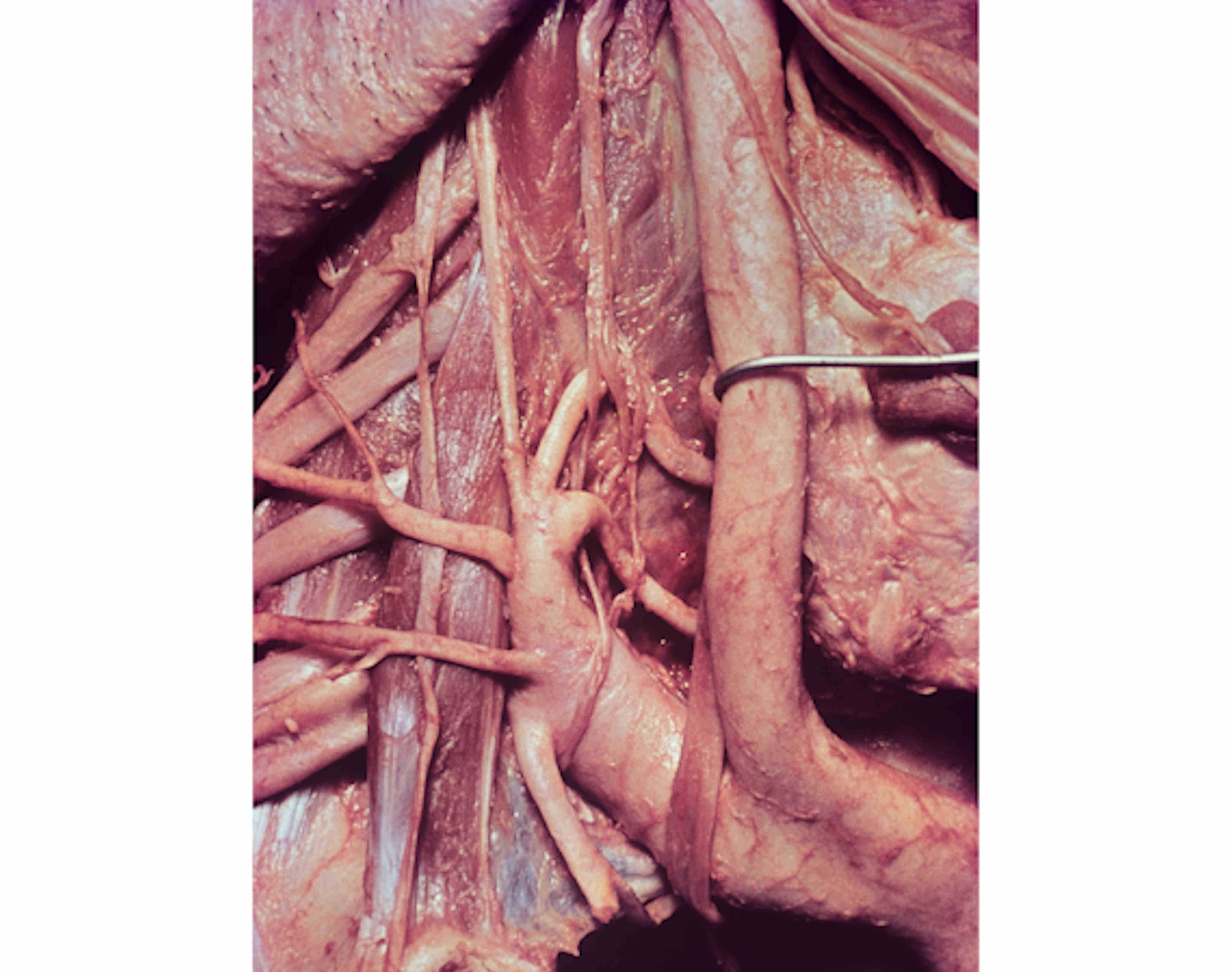 costocervical trunk cadaver